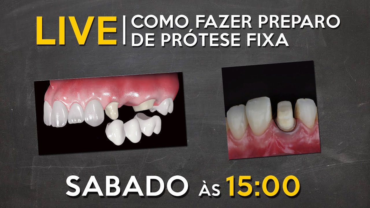 LIVE #060 - Como fazer preparo de prótese fixa