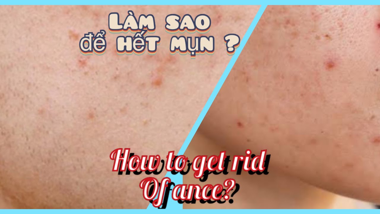 Làm sao để hết mụn.#howtogetridofance. 
