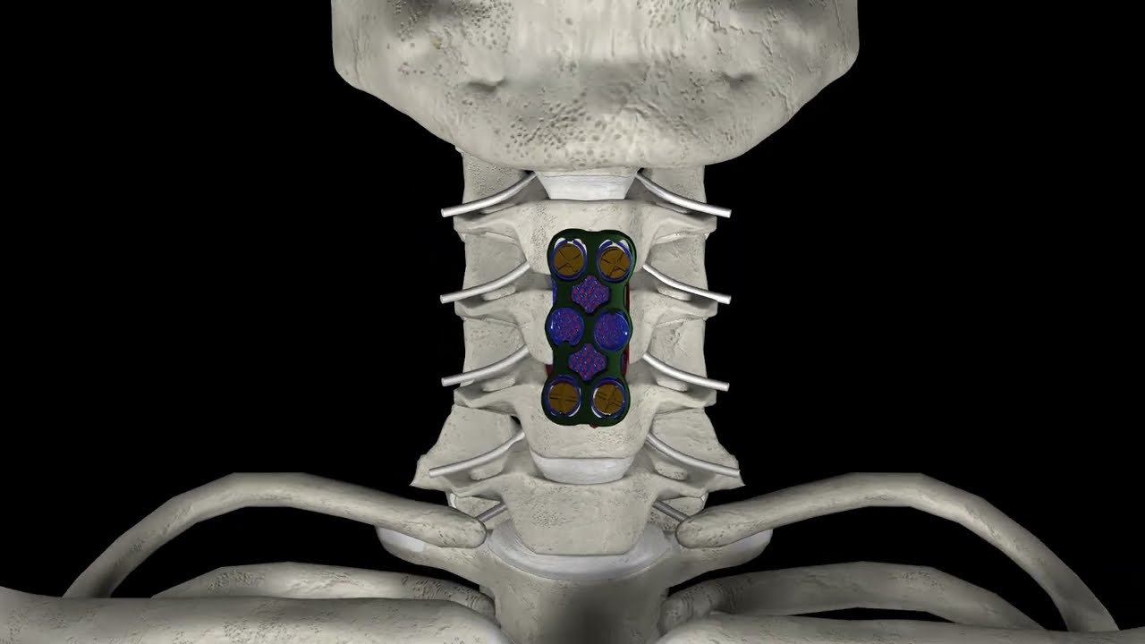 Corpectomia cervical
