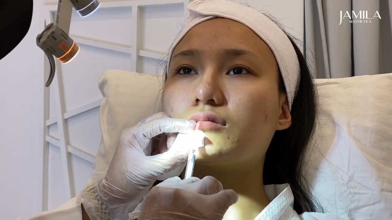 Luscious Lips - Lip Filler