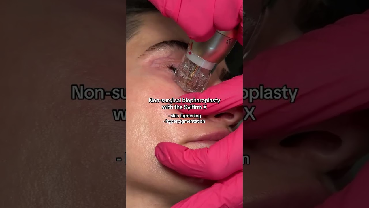 Sylfirm X: The Best Treatment For a Non Surgical Blepharoplasty?