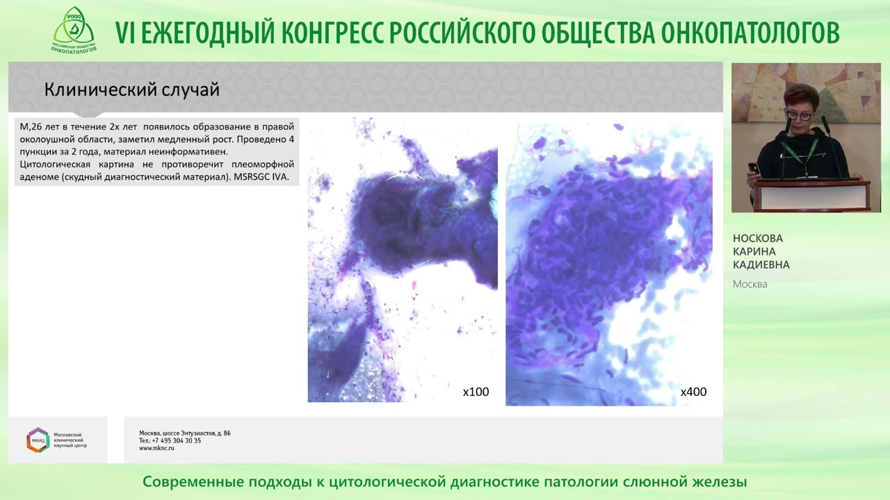 Современные подходы к цитологической диагностике патологии слюнной железы