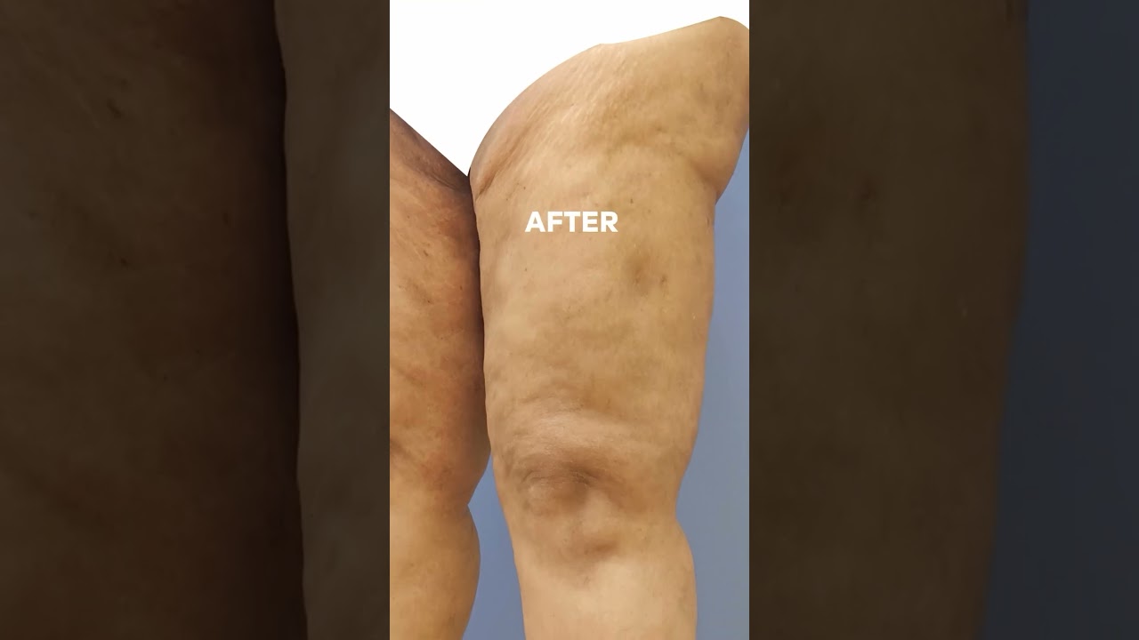 Thigh Liposuction results after 2 years | Before and after #bestplasticsurgeon #care #bengaluru