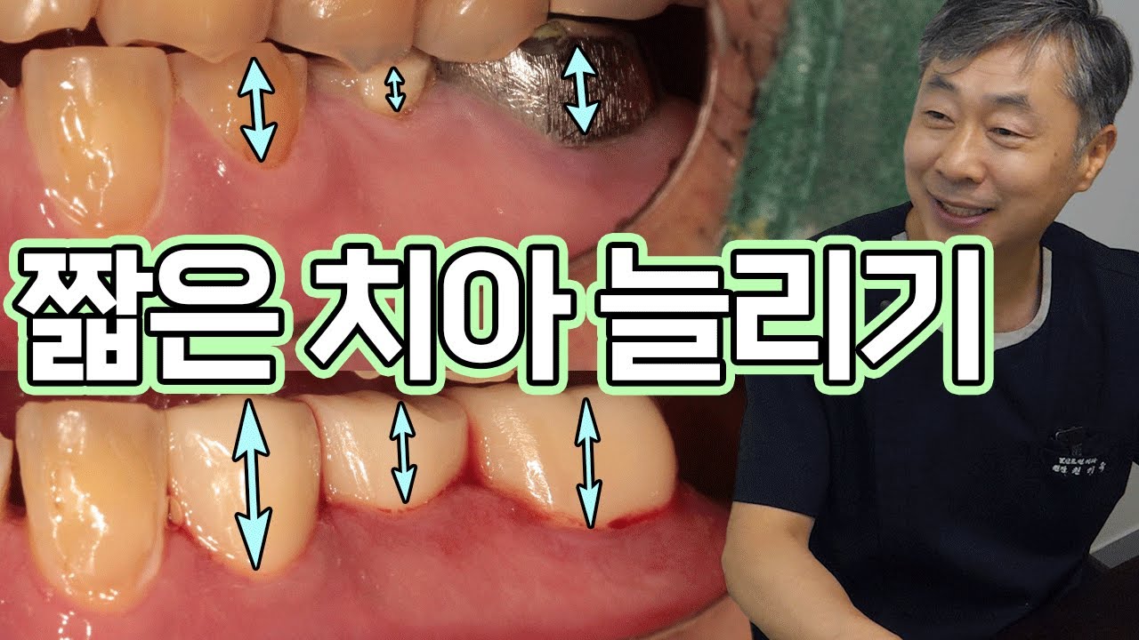 잇몸 위로 짧게 남은 치아 쭈~욱 늘려서 치아 살리기