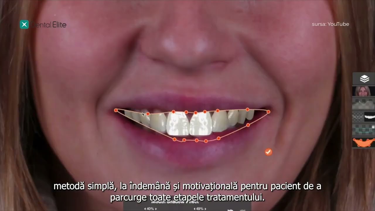 Indicațiile Fațetare cu Dr. Anca Voiculescu