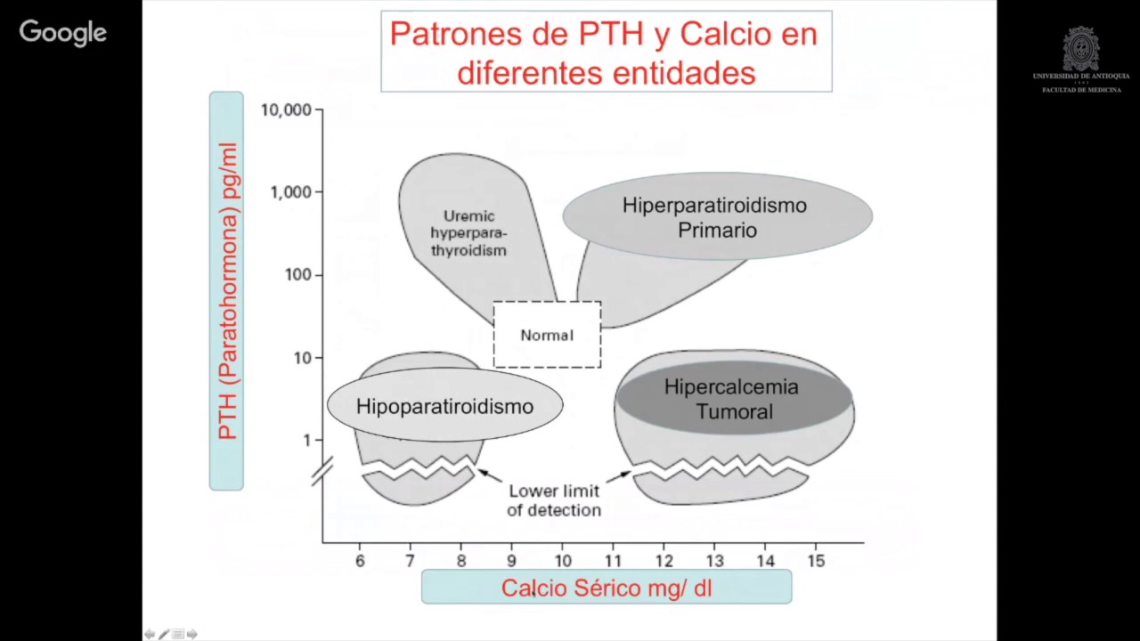 Hiperparatiroidismo primario