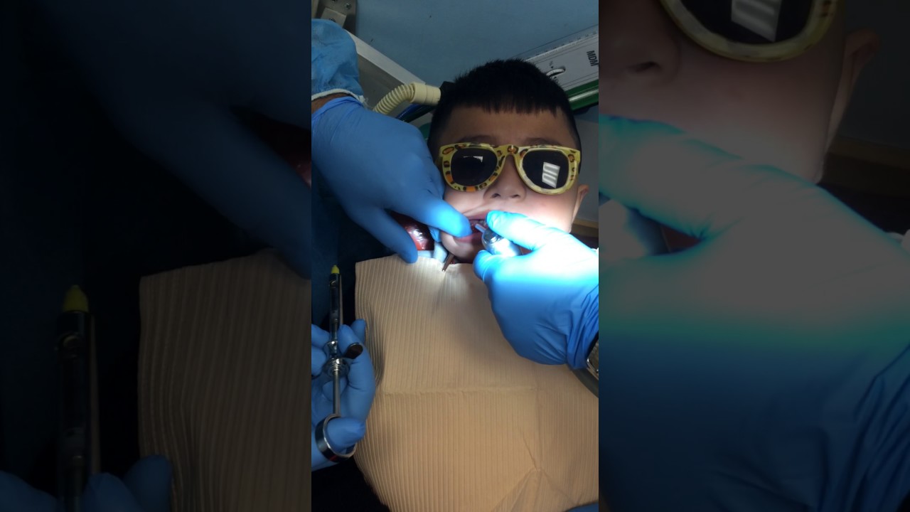 local anesthesia with air technique Dr. Ali Baba Attaie hellsomile pediatric dentistry