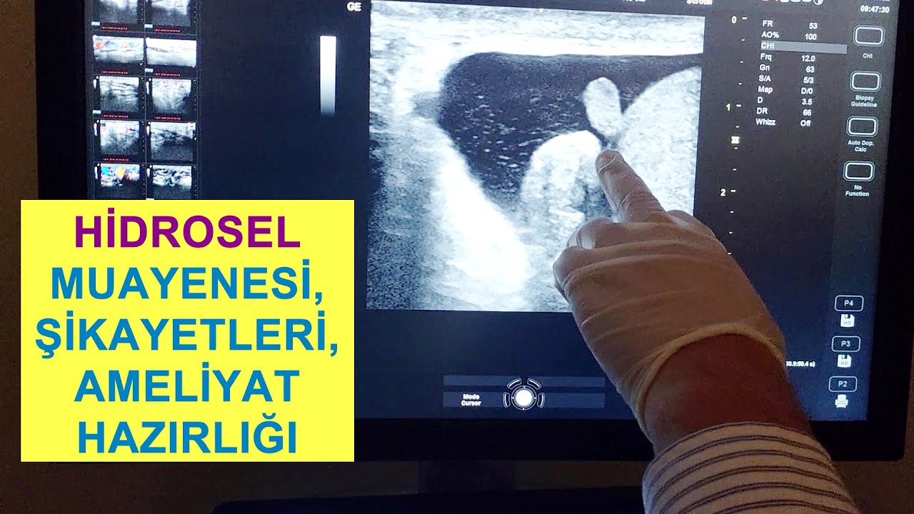 Varikosel Ameliyatı SonrasI Hidrosel Görülür mü? Hidrosel Muayenesi ve Hidrosel Ameliyatı Hazırlığı