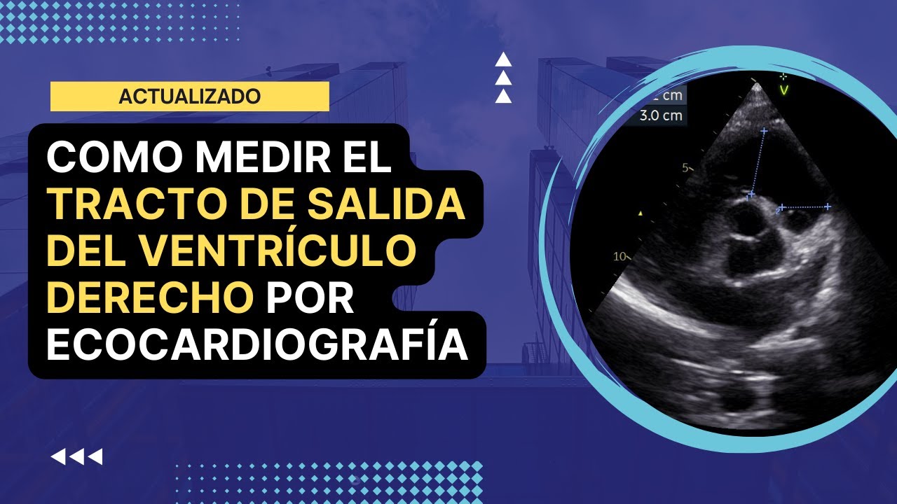 🏅[Cómo medir] el TRACTO DE SALIDA DEL VENTRÍCULO DERECHO (TSVD) por ecocardiografía: Actualizado