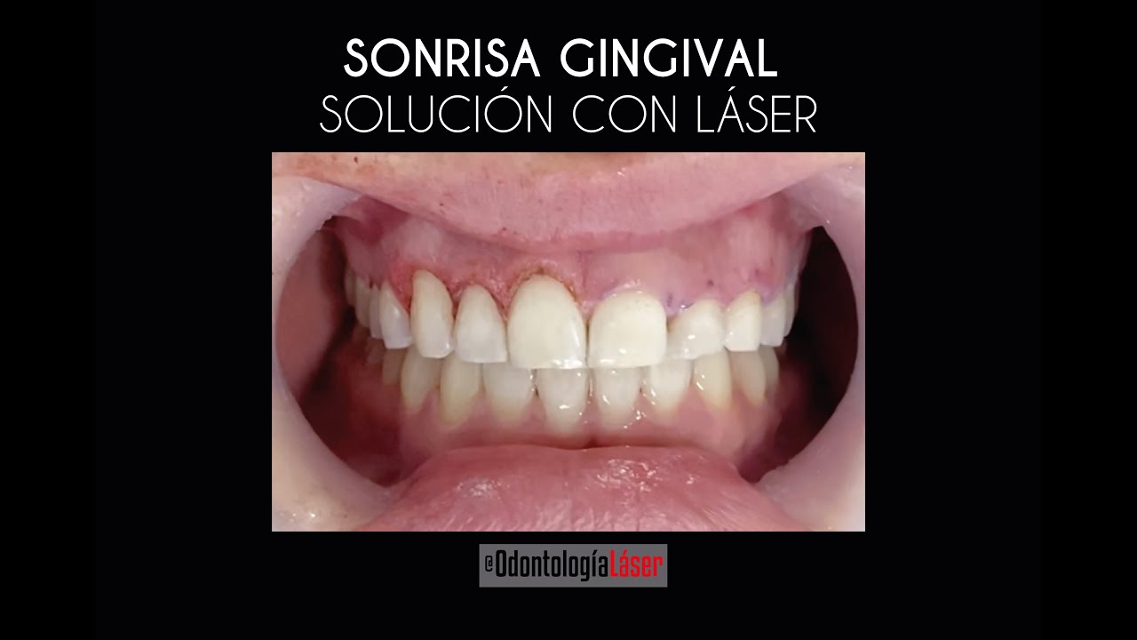 Sonrisa Gingival, solución con Gingivectomía Láser - Odontología Láser.
