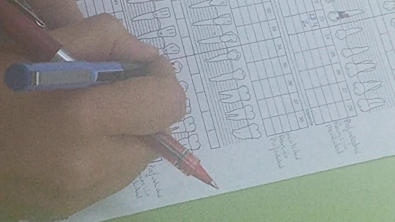 15-Periodontograma, un supuesto