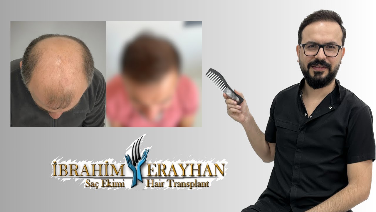 Çok Merak Edilen 2 Seanslık Saç Ekim Sonucu | The Most Curious 2-Session Hair Transplant Result