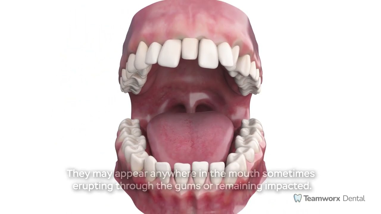 Supernumerary Teeth
