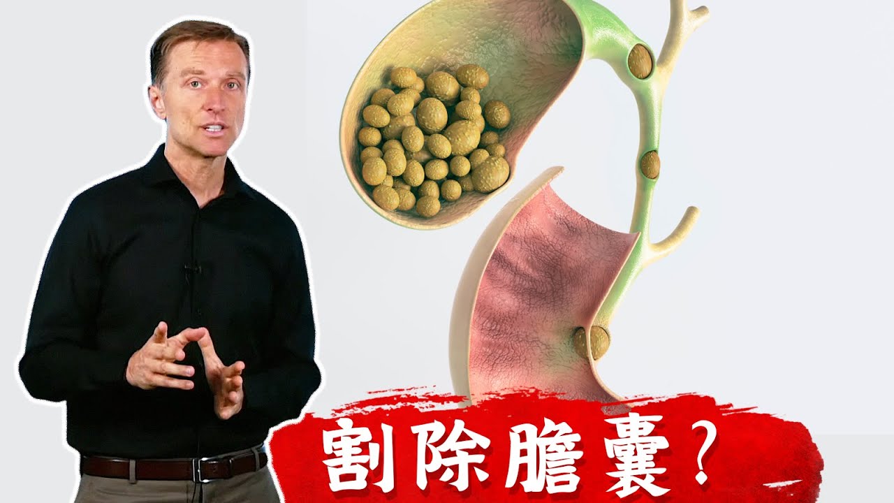 (結石2) 膽結石要割除膽囊嗎？ 膽結石原因？吃什麼飲食溶解結石？柏格醫生dr berg