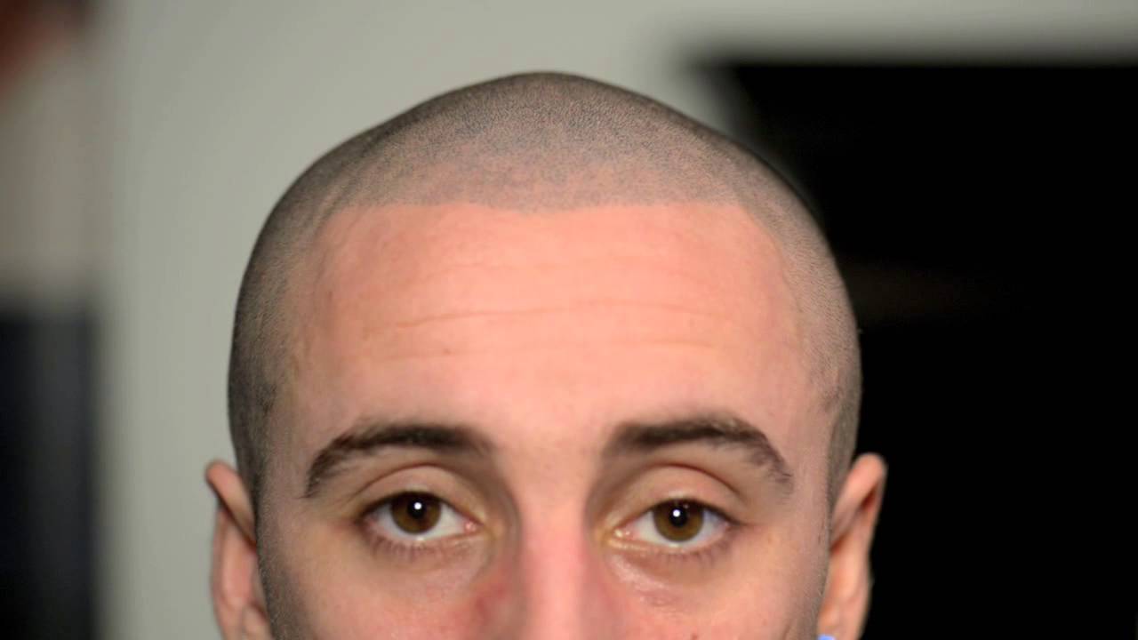 Hair Loss Treatment - David's Thinning Hair Filled in & Hairline Lowered at HIS Hair Clinic (part 2)