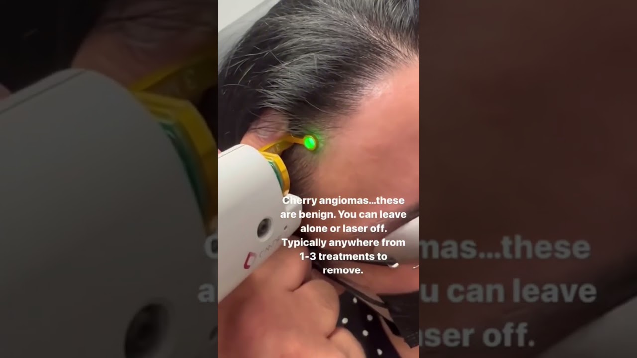 How to get rid of red spots cherry angiomas #shorts