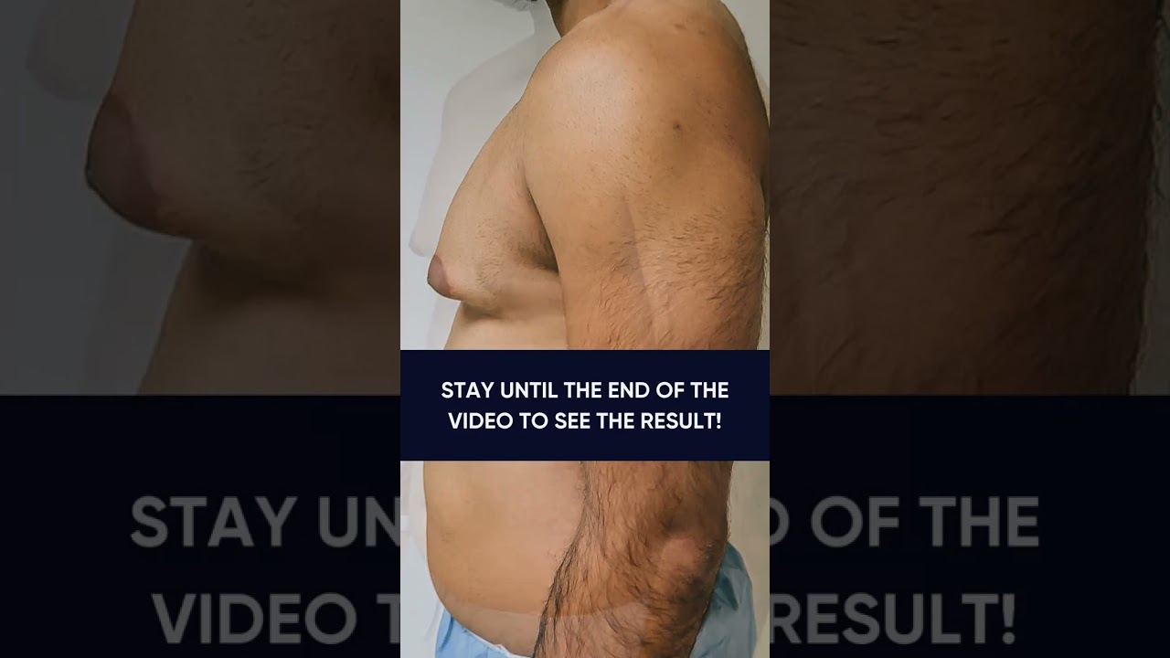 This patient underwent Grade 3 gynecomastia surgery with areola grafting.😮&zwj;💨