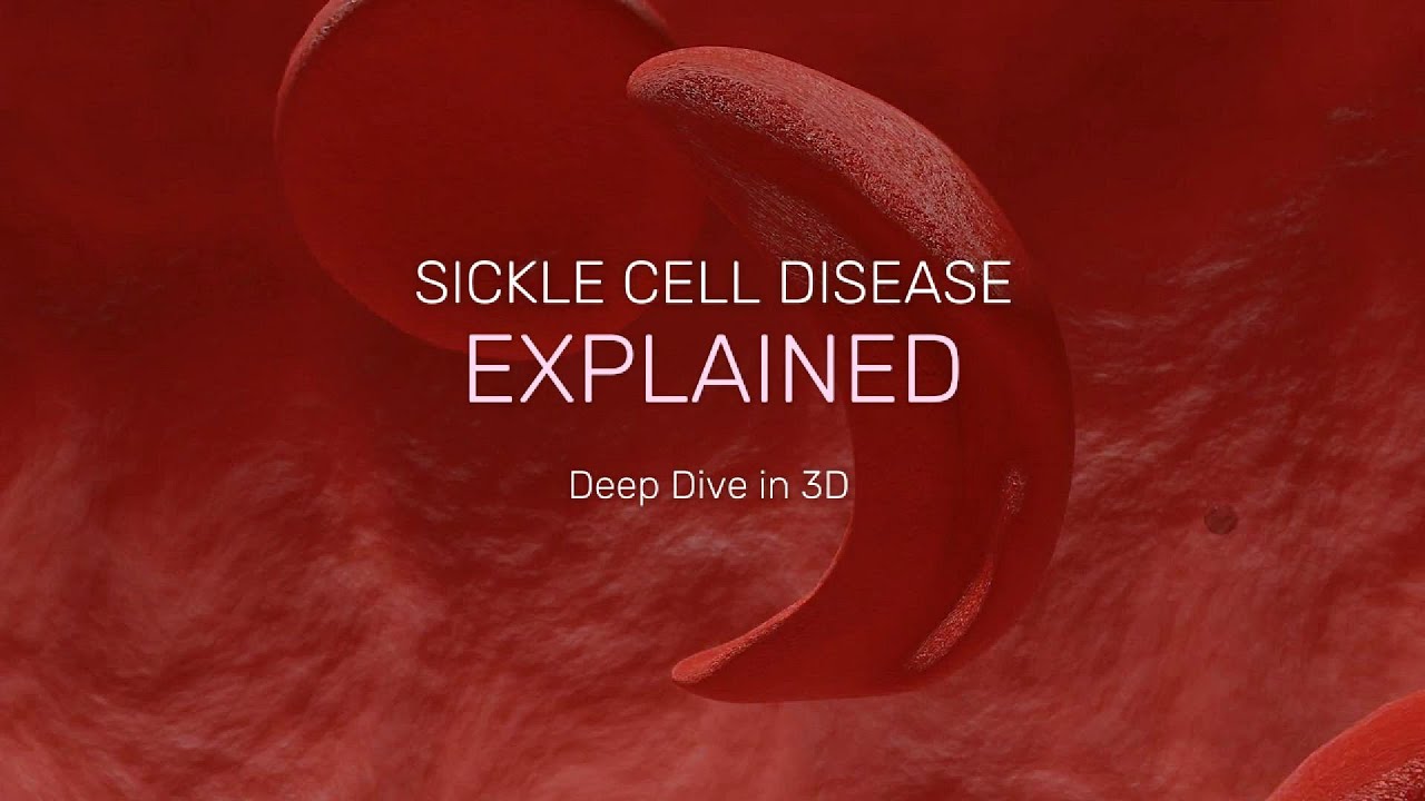 Sickle Cell Anemia Explained Clearly | Understanding Vaso-Occlusive Crisis