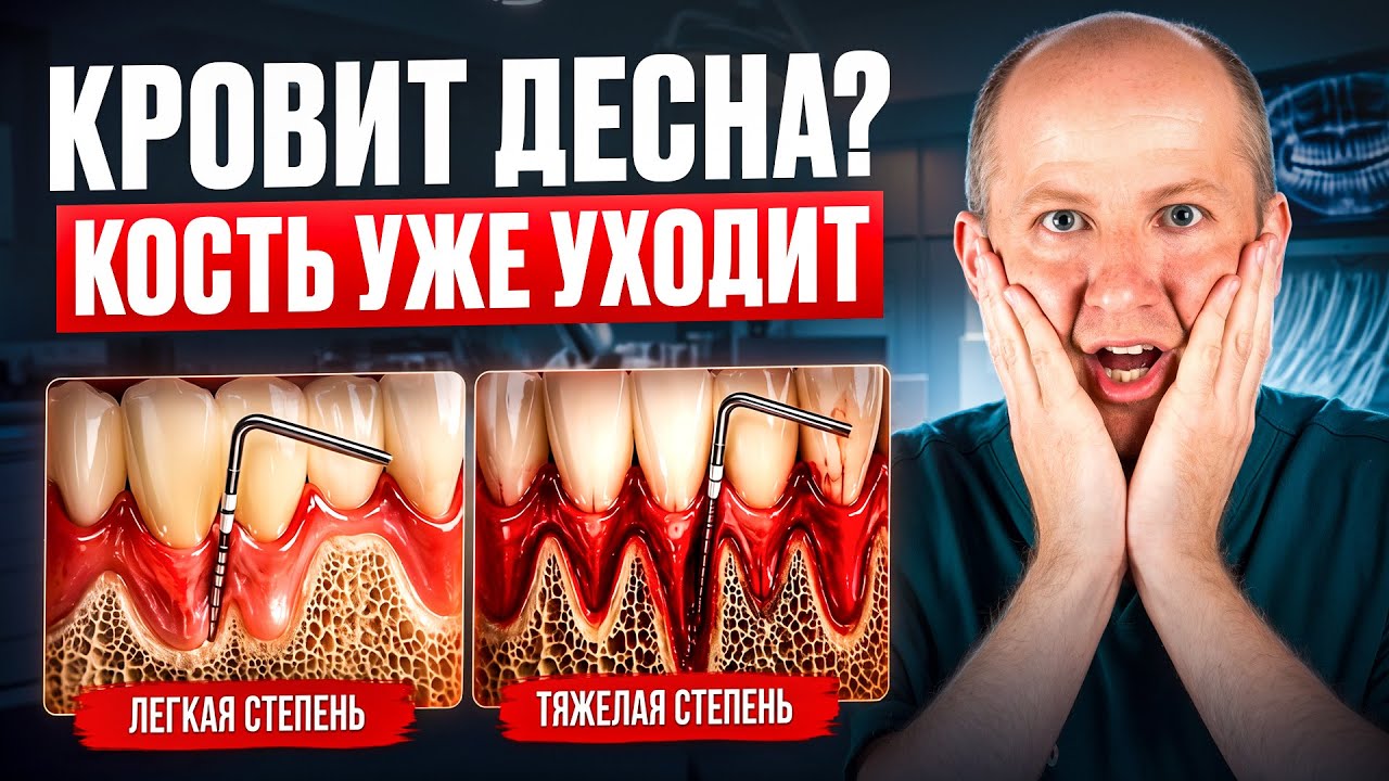 👨‍⚕️ Как лечить воспаление десен?
