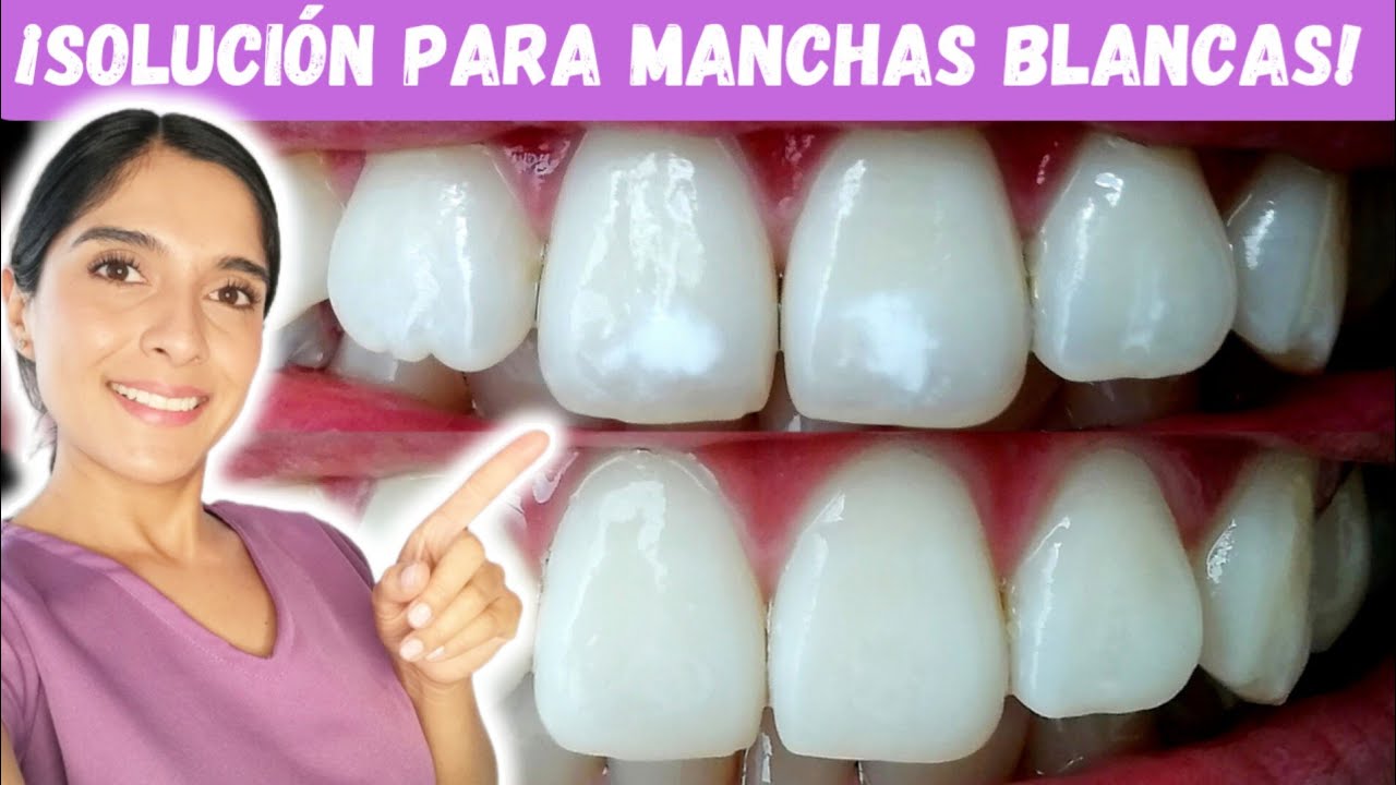 ¡MANCHAS BLANCAS EN LOS DIENTES! | TRATAMIENTO PARA ELIMINARLAS
