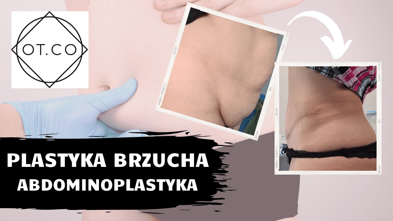 Płaski Brzuch, czyli Abdominoplastyka, na czym polega zabieg - OT.CO Clinic