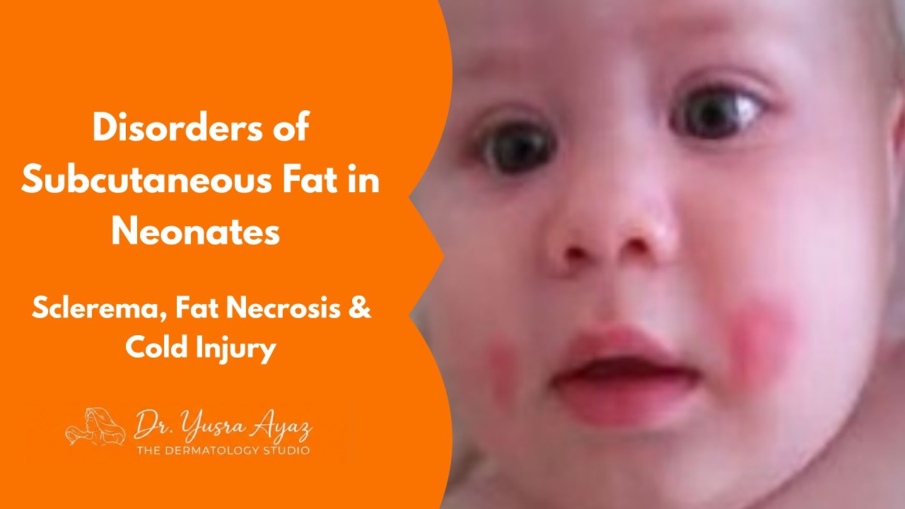 Lecture 4: Disorders of Subcutaneous Fat in Neonates, Sclerema, Fat Necrosis & Cold Injury