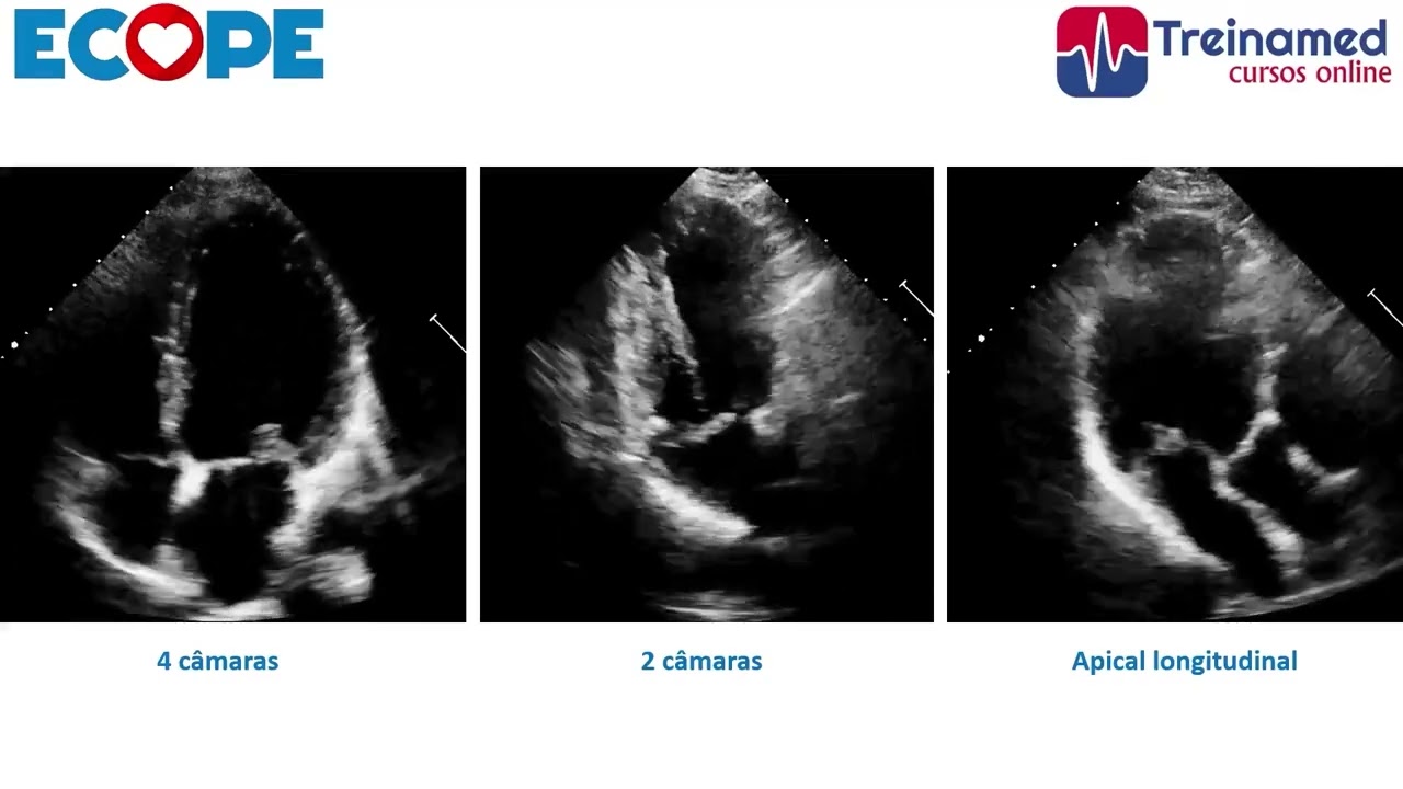 Critérios Ecocardiográficos para o Diagnóstico do Prolapso da Valva Mitral