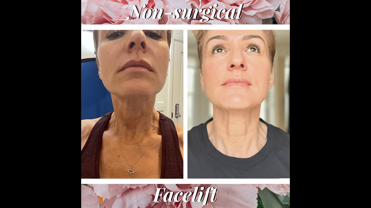 Non Surgical Facelift - ULTRAFORMER 3 - HIFU  - EXPLAINED