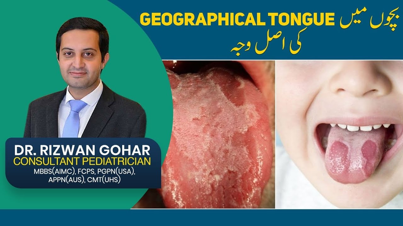 Treatment of Geographic Tongue👅😛 #geographic #tongue #treatment
