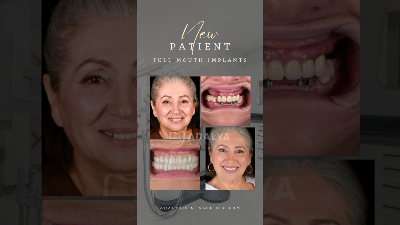 Dental Implants Turkey Antalya - Cost, Packages - Antalya dental Clinic #dentist