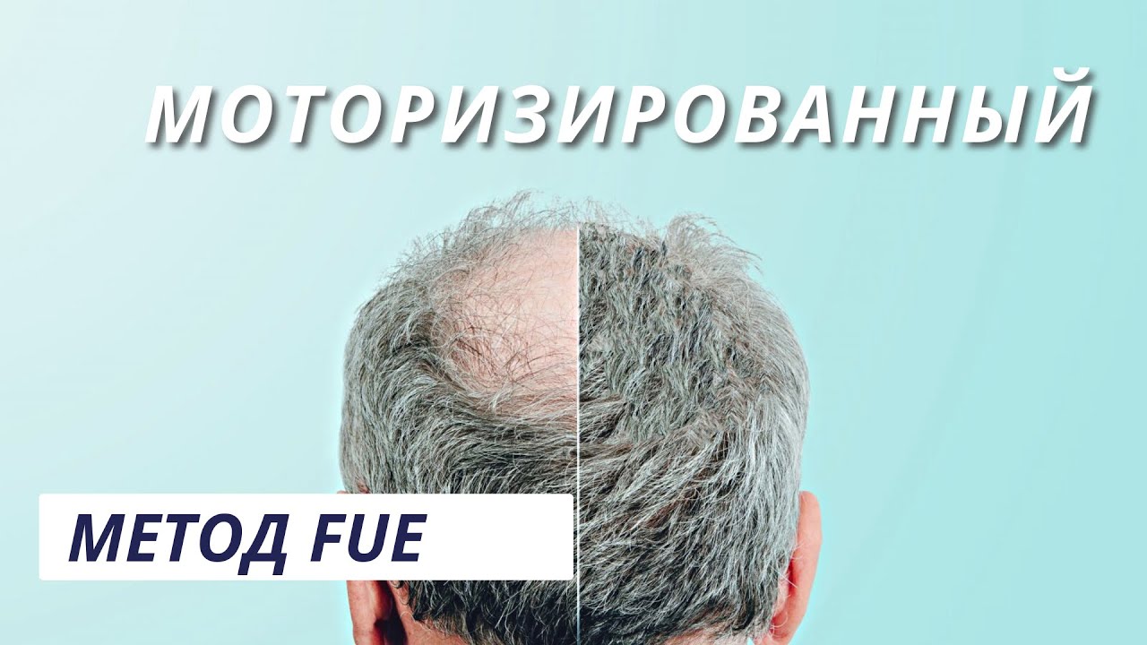 Микромотозированный метод FUE | пересадка волос