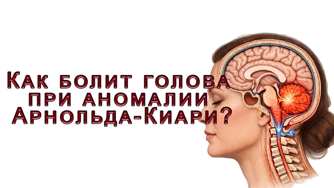 Боль в голове! Аномалия Киари? Что это такое?