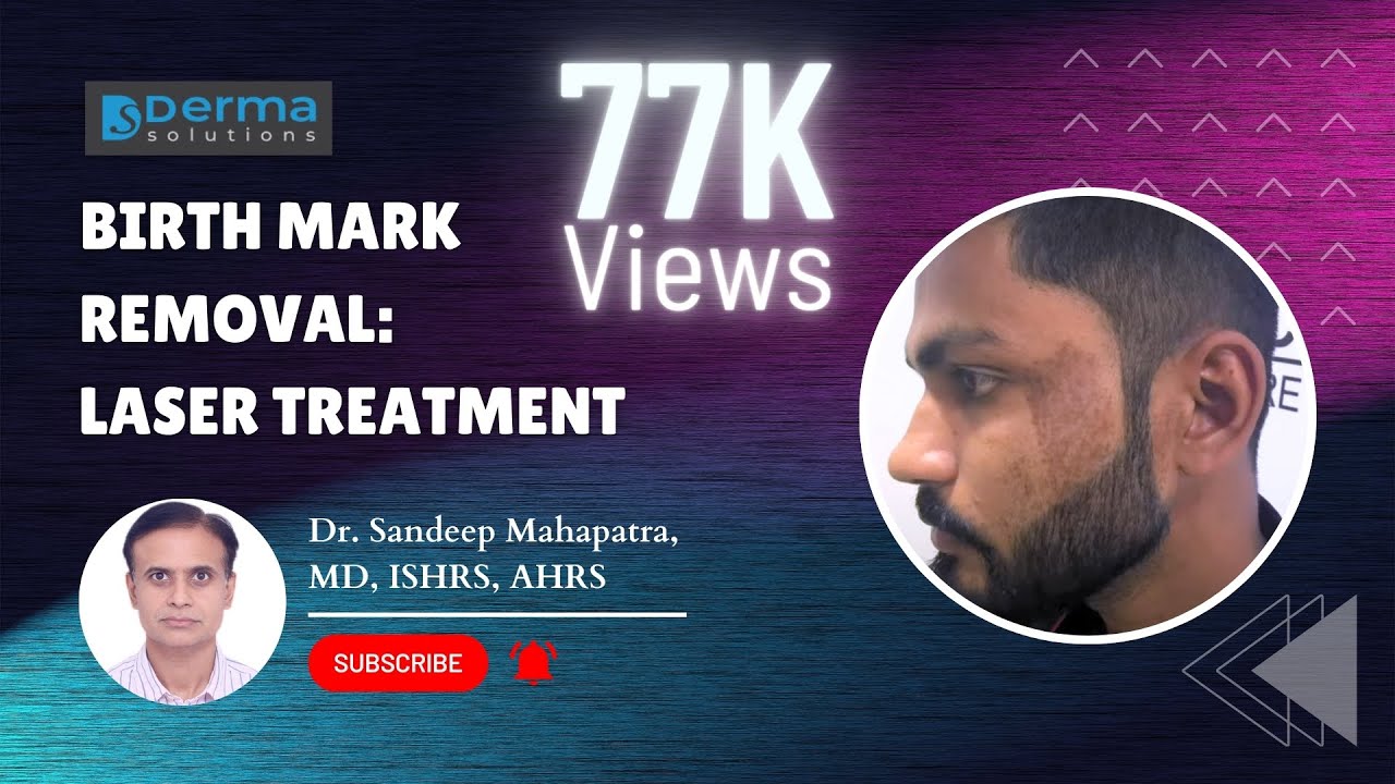 Laser birthmark removal | Laser treatment for birthmarks | BIRTH MARK REMOVAL : LASER TREATMENT
