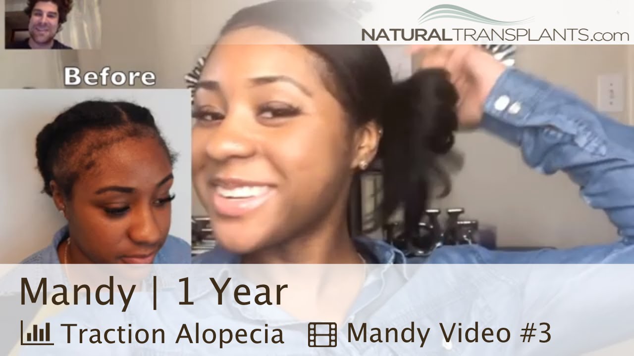 Traction Alopecia Regrowth | I Got My Edges Back After Traction Alopecia (Mandy)