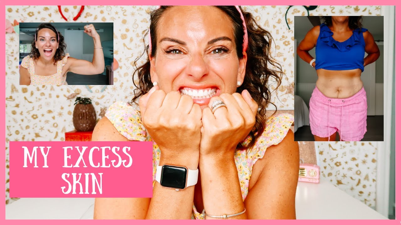 My Loose Skin After Weight Loss Surgery | Gastric Sleeve Surgery Questions & Answers!