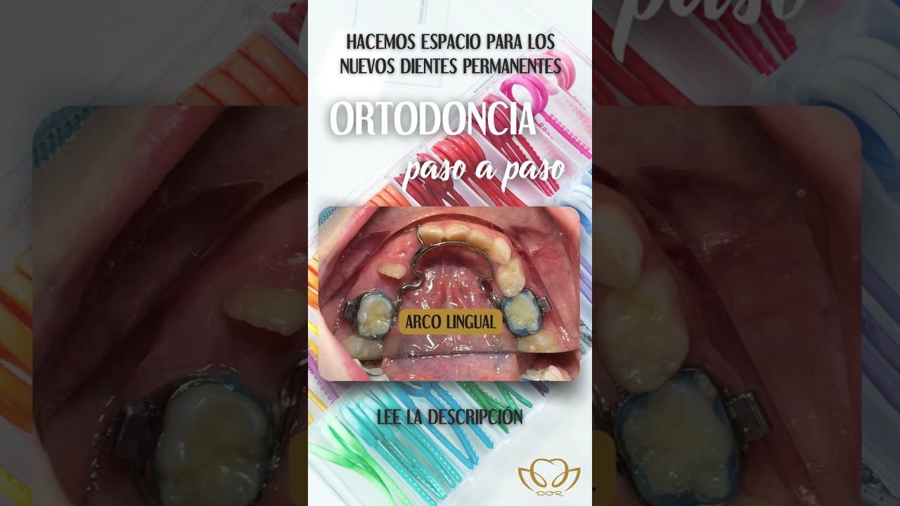 Ortodoncia, ligaduras de separaci&oacute;n y muelles.
