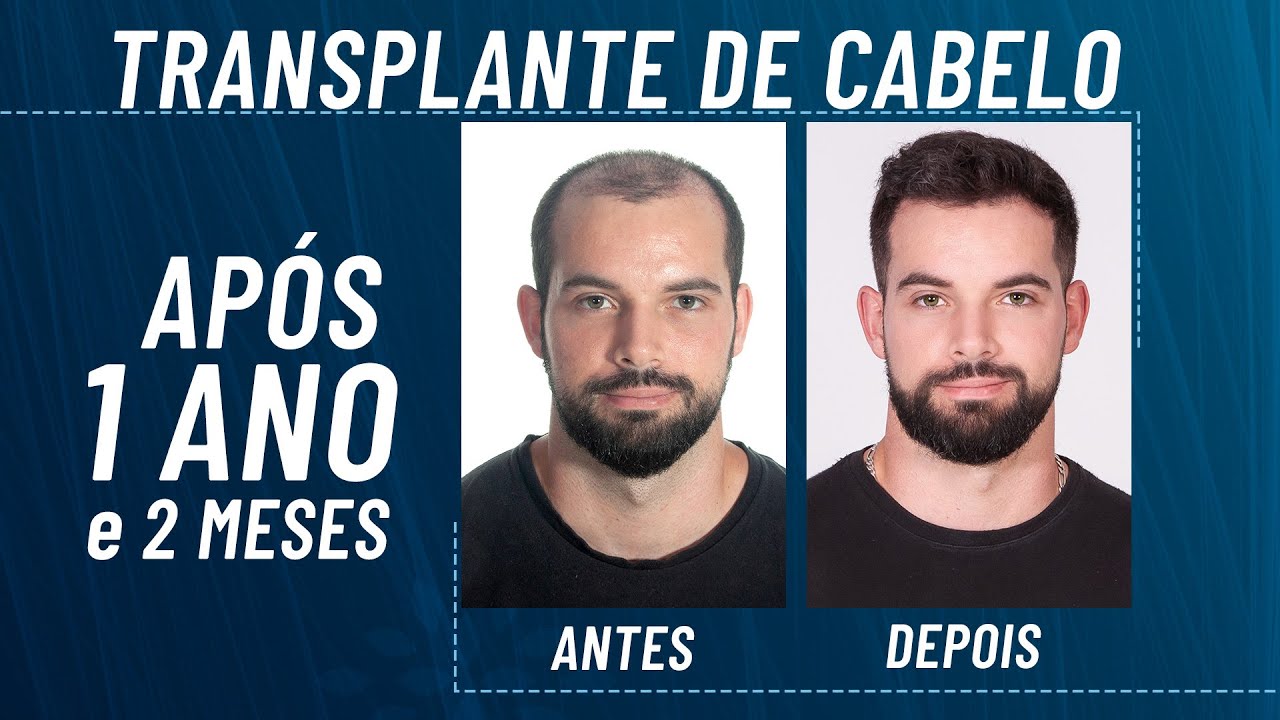 Transplante capilar antes e depois após 1 ano e dois meses