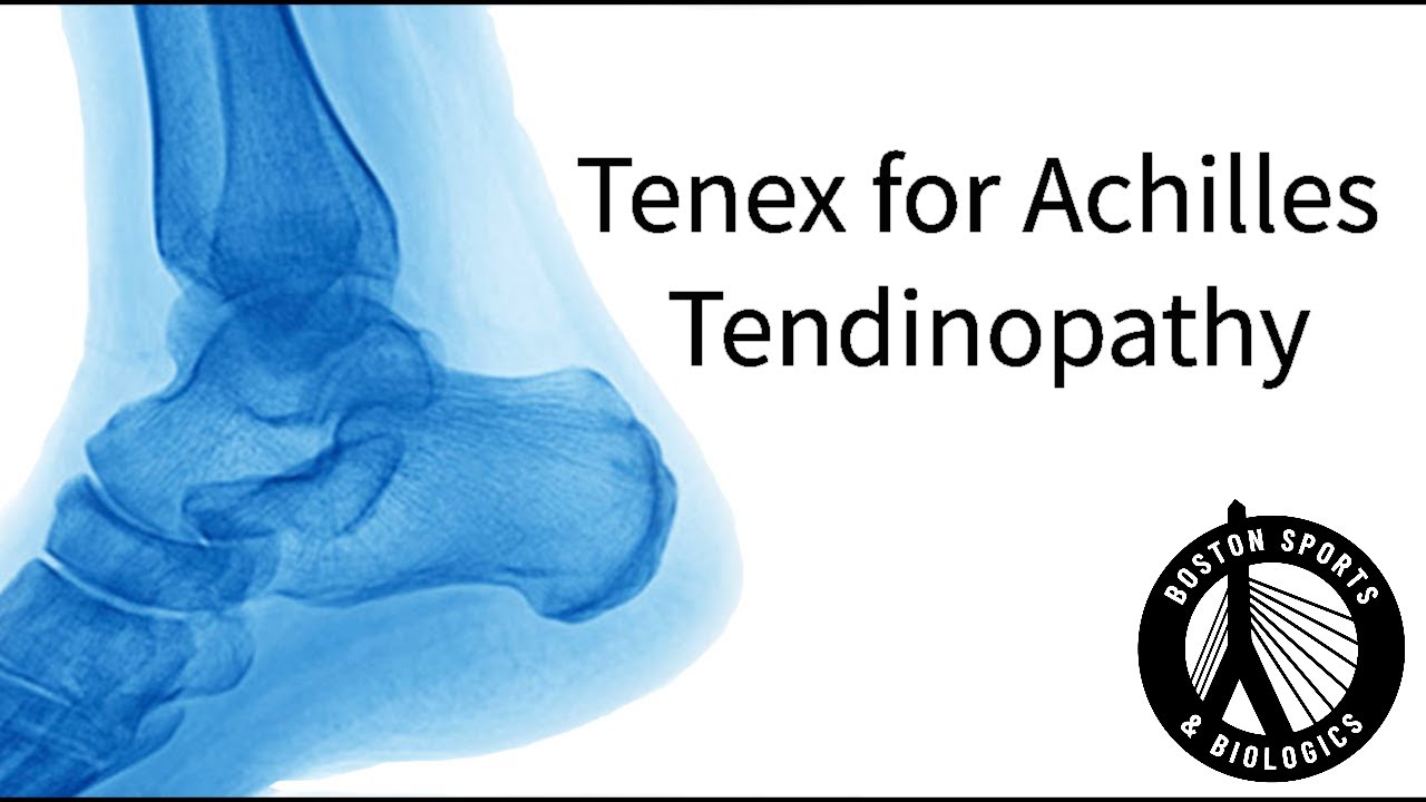 Chronic Achilles Tendon Pain Treatment: Tenex vs. Surgery