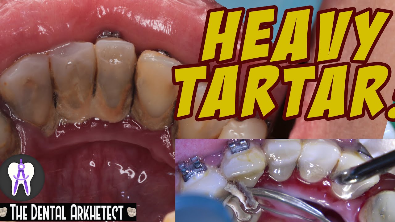 Tooth Cleaning w/ Ultrasonic Scaler (Oral Prophylaxis) 4K #C14