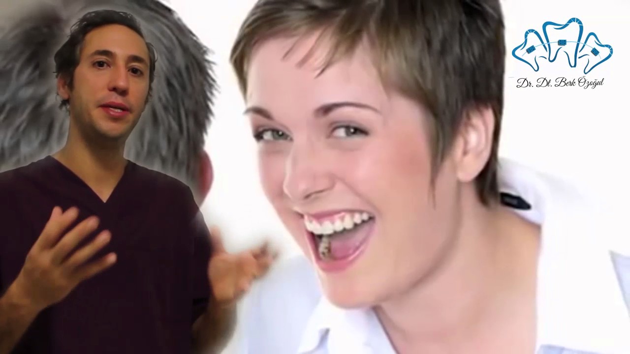 Lingual Diş Teli (İçten Tel Tedavisi)