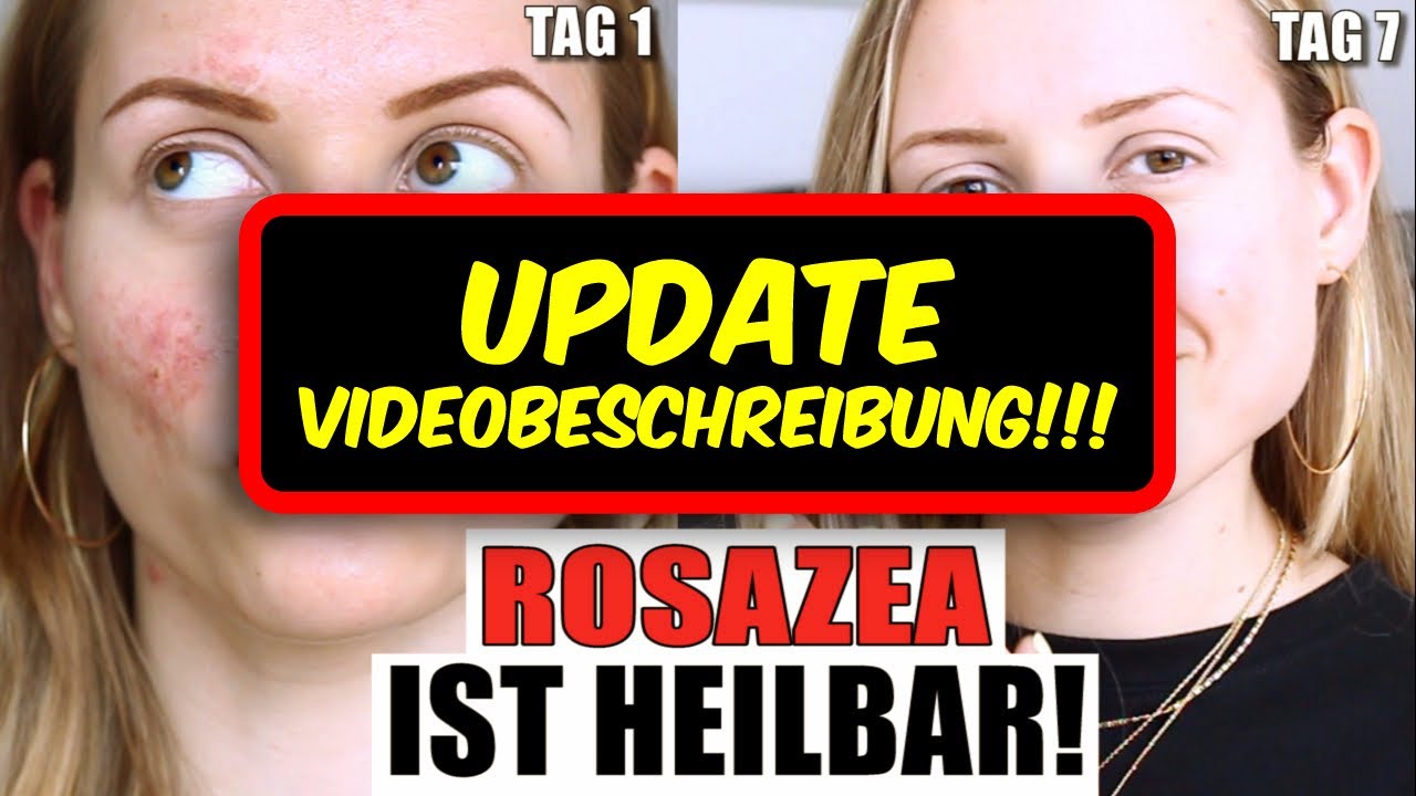 Rosazea HEILMITTEL gefunden! (SIEHE VIDEOBESCHREIBUNG!) NICHT Soolantra | NICHT Retinol  »Lalalunia«