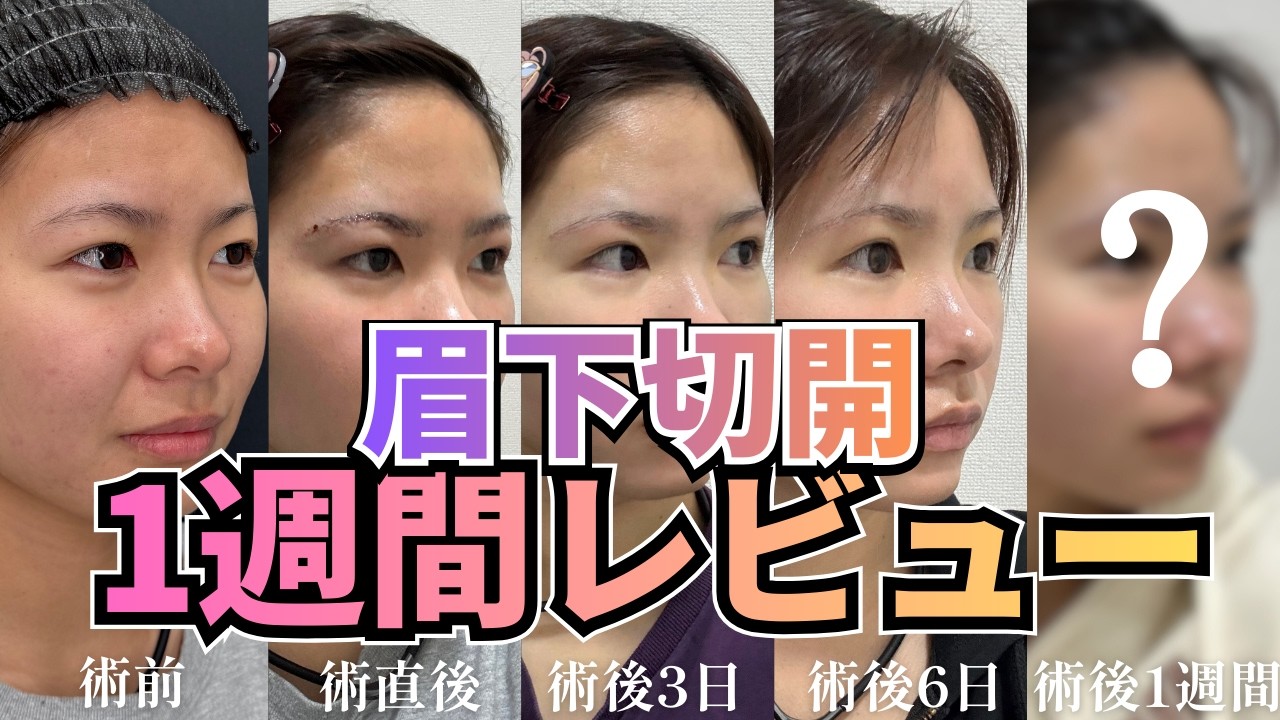 【SBC新百合ヶ丘院】眉下リフト(切開)手術〜ダウンタイム1週間レビュー🗣️