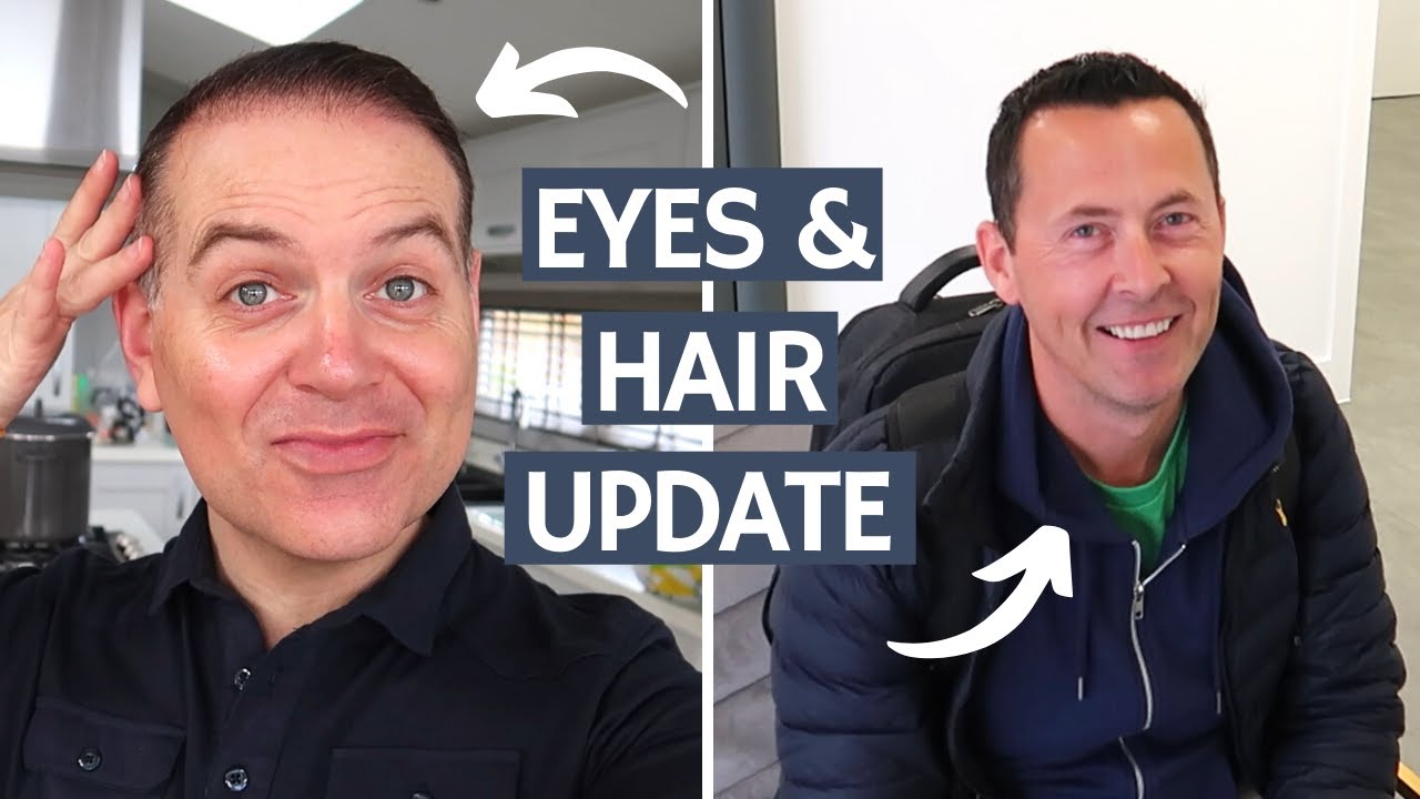 HAIR TRANSPLANT 8 MONTH UPDATE AND NICK GETS HIS EYE BAGS LASERED