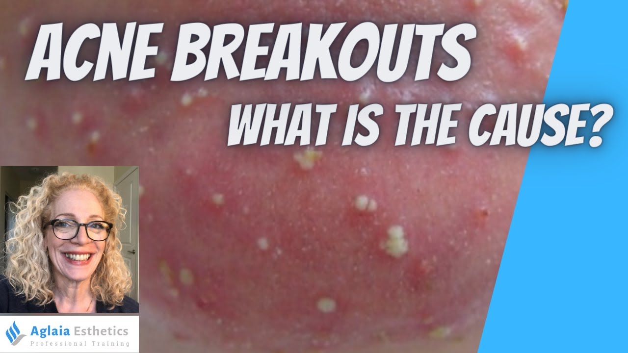 ACNE BREAKOUTS - SURPRISING TRUTH ABOUT STUBBORN ACNE!