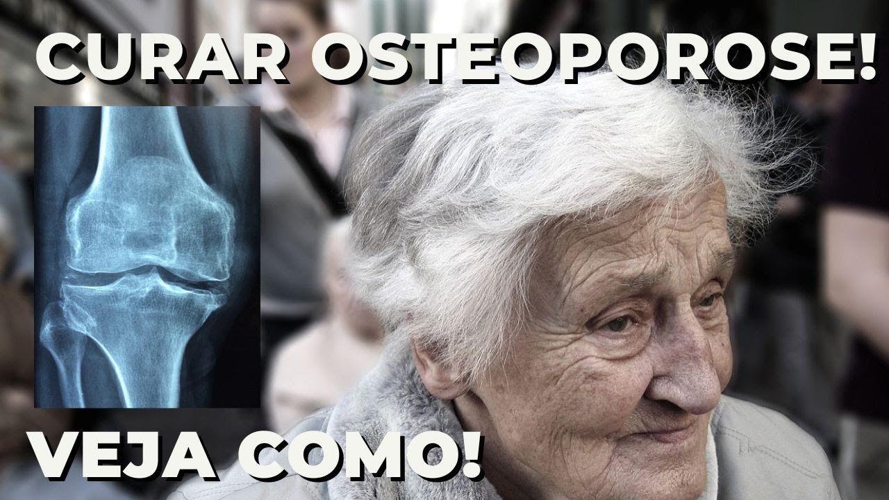 M&eacute;todo infal&iacute;vel para tratar osteoporose! Tenha ossos fortes!
