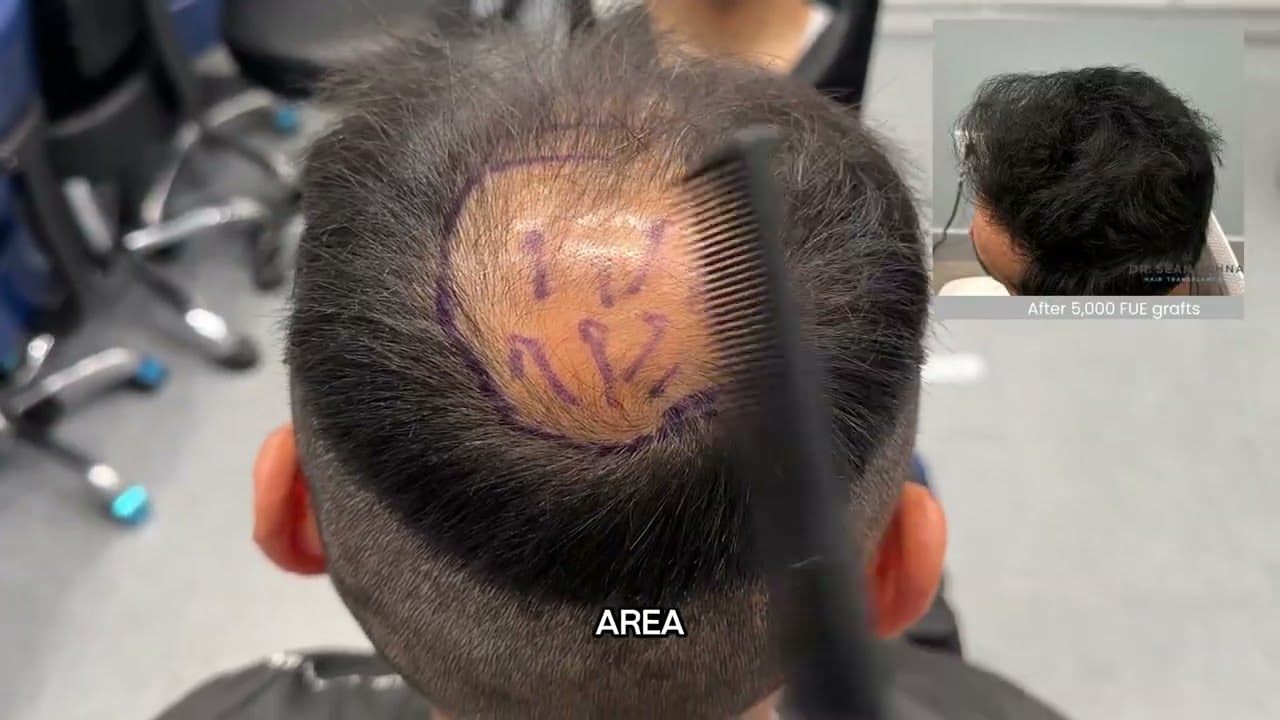 5,000 Grafts FUE Class 6 Norwood Hairloss - Dr. Sean Behnam