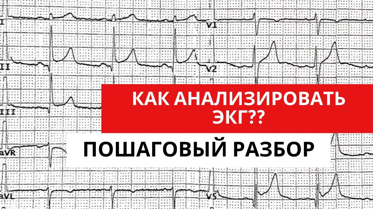 Анализ ЭКГ. Пошаговый разбор.