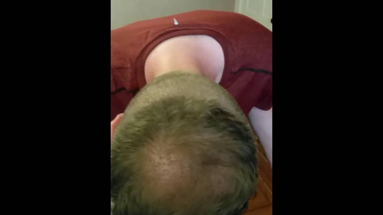 My Hair Transplant Experience - Day 7 | The Toronto Hair Transplant Clinic