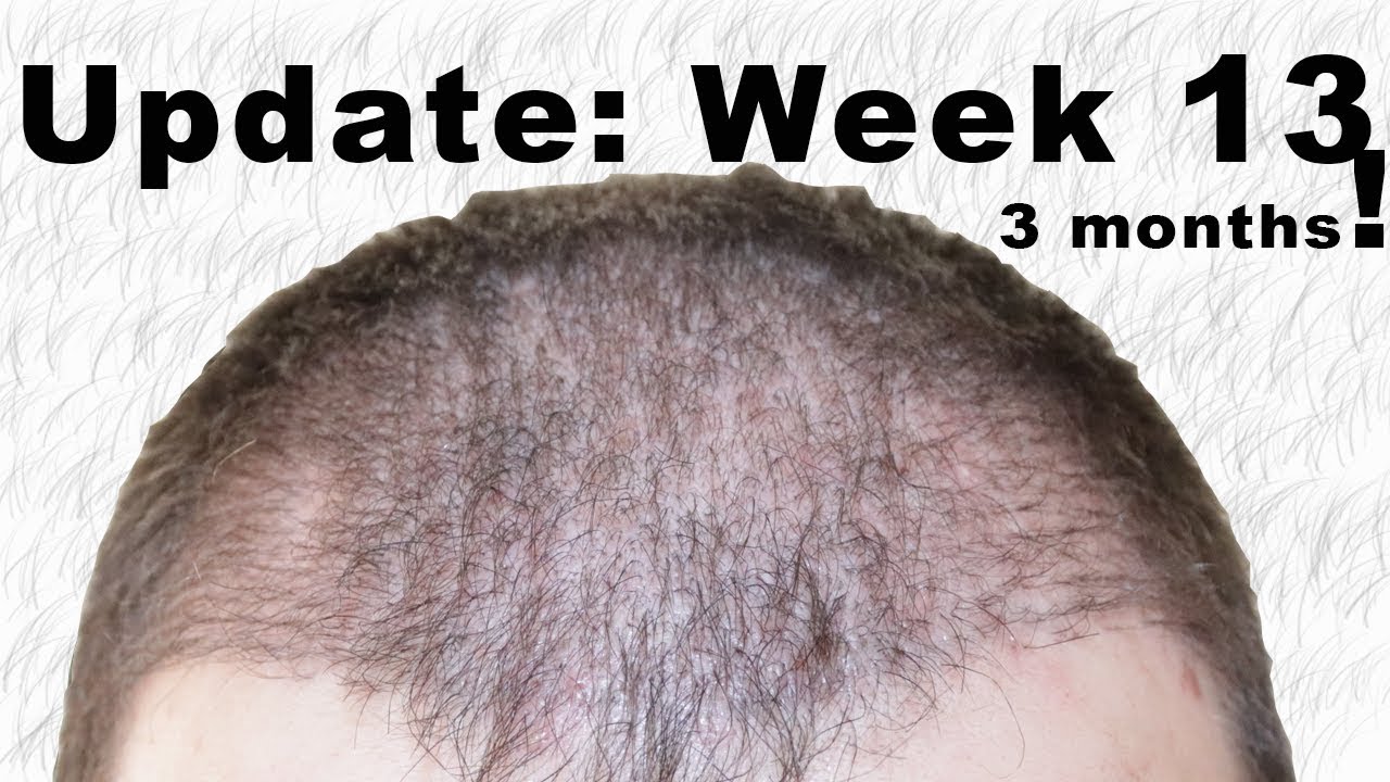 13 Weeks Post Operation