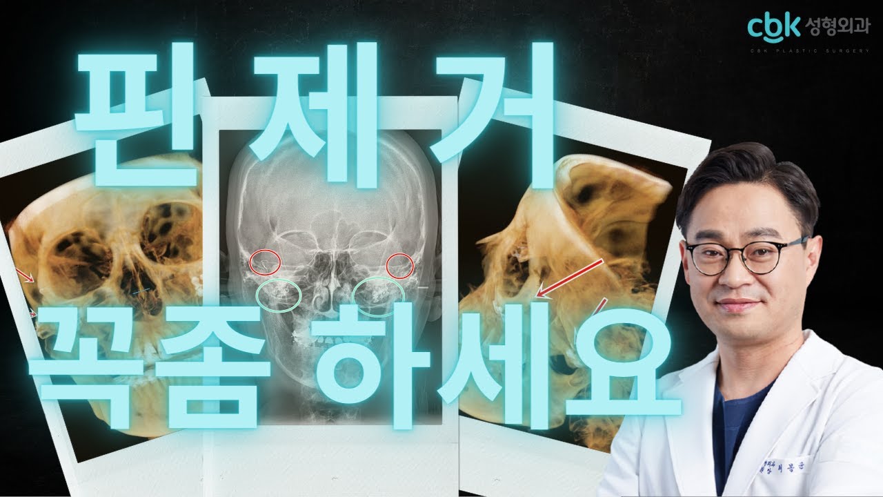[닥터봉TV_CBK성형외과_최봉균]이러시면 안됩니다! 안면윤곽 양악수술 부작용으로 인한 재수술시 고정핀제거는 필수[CBK整形外科チェボンギュン] 輪郭両顎手術の再手術時固定ピン除去は必須